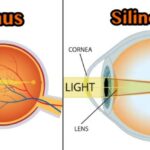 hipwee-Lasik-corrects-myopia-side-640x326