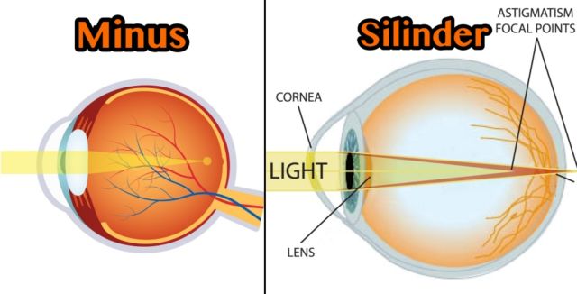 hipwee-Lasik-corrects-myopia-side-640x326