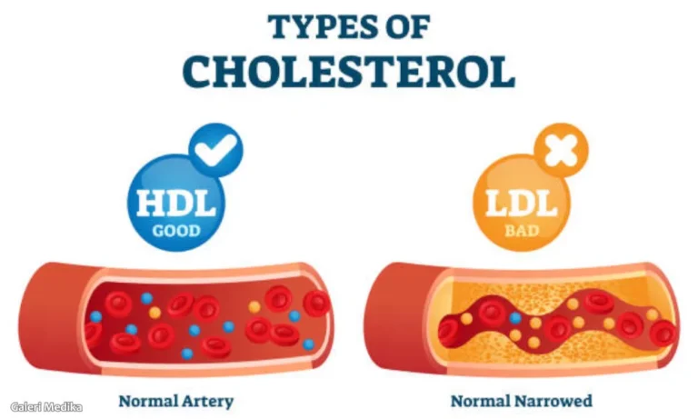 afblg-hdl-ldl