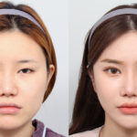 Before_after_Rhinoplasty_AB_Plastic_Surgery_Korea_16100411_438051
