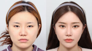 Before_after_Rhinoplasty_AB_Plastic_Surgery_Korea_16100411_438051